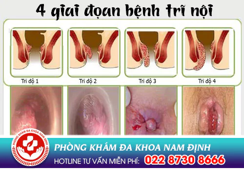 các cấp độ của trĩ nội